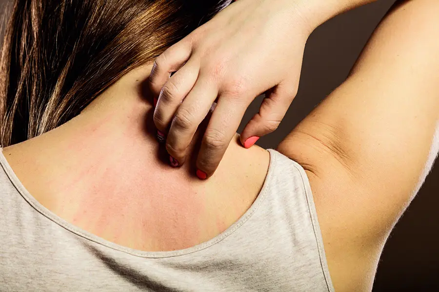 Fisetin: A Natural Solution for Itch Relief